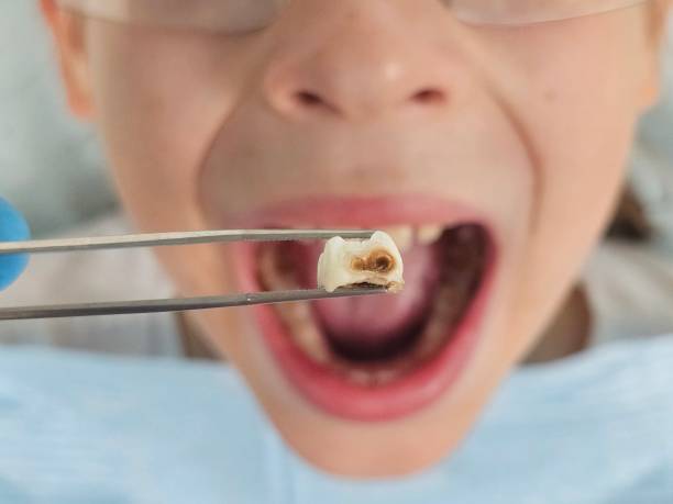 Best Dental Abscess Treatment in Powhatan Point, OH
